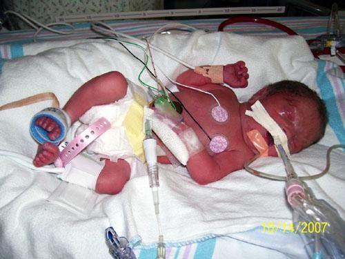 Sofia in the NICU where she was born...