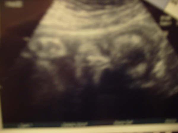 First ultrasound picture.