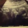 First ultrasound picture.