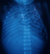 RCDH X-ray